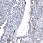 Immunohistochemical staining of human ovarian cancer (papillary carcinoma) shows moderate membranous positivity in a subset of tumor cells.
