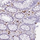Immunohistochemical staining of human colon shows strong cytoplasmic positivity in lymphoid cells.