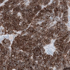 Immunohistochemical staining of human ovarian cancer (endometrioid carcinoma) shows strong membranous positivity in tumor cells.
