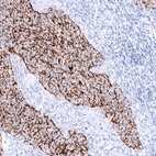 Immunohistochemical staining of human endometrial cancer shows strong membranous positivity in tumor cells.