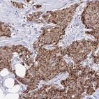 Immunohistochemical staining of human Breast cancer shows strong granular cytoplasmic positivity in tumor cells.