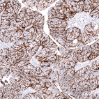 Immunohistochemical staining of human colorectal cancer (metastasis to ovary) shows strong membranous positivity in tumor cells.