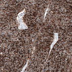 Immunohistochemical staining of human ovarian cancer (high grade serous carcinoma) shows strong membranous positivity in tumor cells.