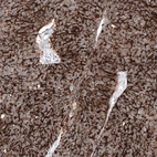 Immunohistochemical staining of human ovarian cancer (high grade serous carcinoma) shows strong membranous positivity in tumor cells.