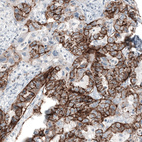 Immunohistochemical staining of human ovarian cancer (endometrioid carcinoma) shows strong membranous positivity in tumor cells.