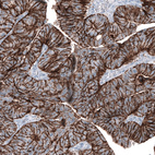 Immunohistochemical staining of human colorectal cancer (metastasis to ovary) shows strong membranous positivity in tumor cells.