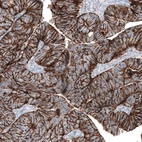 Immunohistochemical staining of human colorectal cancer (metastasis to ovary) shows strong membranous positivity in tumor cells.