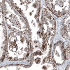 Immunohistochemical staining of human ovarian cancer (clear cell carcinoma) shows strong membranous positivity in tumor cells.