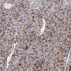 Immunohistochemical staining of human ovarian cancer (endometrioid carcinoma) shows strong membranous positivity in tumor cells.