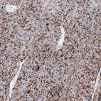 Immunohistochemical staining of human ovarian cancer (endometrioid carcinoma) shows strong membranous positivity in tumor cells.