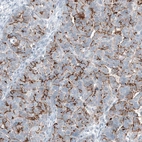 Immunohistochemical staining of human ovarian cancer (papillary carcinoma) shows strong membranous positivity in tumor cells.