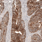 Immunohistochemical staining of human colorectal cancer shows strong membranous positivity in tumor cells.