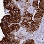Immunohistochemical staining of human colorectal cancer shows strong cytoplasmic positivity in tumor cells.