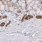 Immunohistochemical staining of human stomach tumor (enterochromaffin-like cell carcinoid) shows strong cytoplasmic positivity in tumor cells.