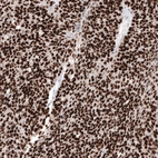 Immunohistochemical staining of human ovarian cancer (high grade serous carcinoma) shows strong nuclear positivity in tumor cells.