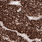 Immunohistochemical staining of human ovarian cancer (endometrioid carcinoma) shows strong nuclear positivity in tumor cells.