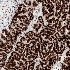 Immunohistochemical staining of human ovarian cancer (papillary carcinoma) shows strong nuclear positivity in tumor cells.