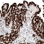 Immunohistochemical staining of human ovarian cancer (papillary carcinoma) shows strong nuclear positivity in tumor cells.