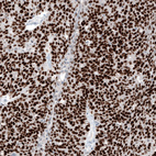 Immunohistochemical staining of human ovarian cancer (high grade serous carcinoma) shows strong nuclear positivity in tumor cells.