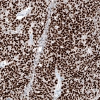 Immunohistochemical staining of human ovarian cancer (high grade serous carcinoma) shows strong nuclear positivity in tumor cells.