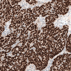 Immunohistochemical staining of human ovarian cancer (endometrioid carcinoma) shows strong nuclear positivity in tumor cells.