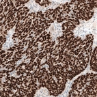 Immunohistochemical staining of human ovarian cancer (endometrioid carcinoma) shows strong nuclear positivity in tumor cells.