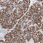 Immunohistochemical staining of human ovarian cancer (endometrioid carcinoma) shows strong nuclear positivity in tumor cells.
