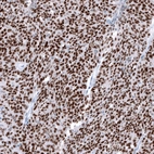 Immunohistochemical staining of human ovarian cancer (high grade serous carcinoma) shows strong nuclear positivity in tumor cells.
