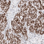 Immunohistochemical staining of human ovarian cancer (papillary carcinoma) shows strong nuclear positivity in tumor cells.