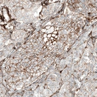 Immunohistochemical staining of human breast cancer (metastasis to ovary) shows moderate membranous positivity in tumor cells.