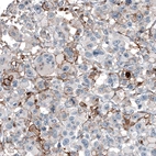 Immunohistochemical staining of human malignant melanoma shows moderate membranous positivity in tumor cells.