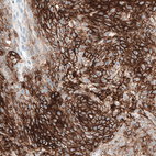 Immunohistochemical staining of human cervical cancer shows strong membranous positivity in tumor cells.