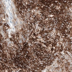 Immunohistochemical staining of human cervical cancer shows strong membranous positivity in tumor cells.
