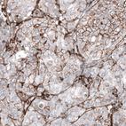 Immunohistochemical staining of human breast cancer (metastasis to ovary) shows moderate membranous positivity in tumor cells.