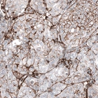 Immunohistochemical staining of human breast cancer (metastasis to ovary) shows moderate membranous positivity in tumor cells.