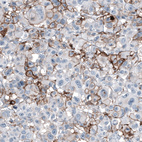 Immunohistochemical staining of human malignant melanoma shows moderate membranous positivity in tumor cells.