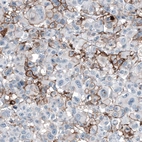 Immunohistochemical staining of human malignant melanoma shows moderate membranous positivity in tumor cells.
