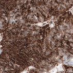 Immunohistochemical staining of human ovarian cancer (endometrioid carcinoma) shows strong membranous positivity in tumor cells.