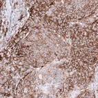 Immunohistochemical staining of human cervical cancer shows strong membranous positivity in tumor cells.