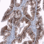 Immunohistochemical staining of human ovarian cancer (low grade carcinoma) shows moderate membranous positivity in tumor cells.