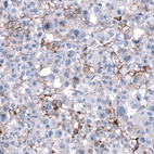 Immunohistochemical staining of human malignant melanoma shows moderate membranous positivity in tumor cells.