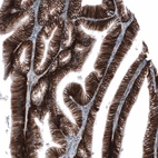 Immunohistochemical staining of human ovarian cancer (low grade carcinoma) shows strong membranous positivity in tumor cells.