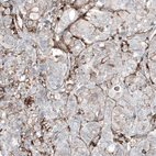 Immunohistochemical staining of human breast cancer (metastasis to ovary) shows moderate membranous positivity in tumor cells.