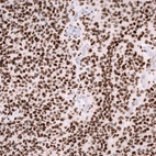 Immunohistochemical staining of human anaplastic oligodendroglioma shows strong nuclear positivity in tumor cells.