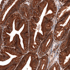 Immunohistochemical staining of human ovarian cancer (low grade serous ovarian carcinoma) shows strong membranous positivity in tumor cells.