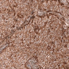 Immunohistochemical staining of human endometrial cancer shows strong membranous positivity in tumor cells.