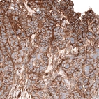 Immunohistochemical staining of human ovarian cancer (papillary carcinoma) shows strong membranous positivity in tumor cells.