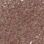 Immunohistochemical staining of human anaplastic oligodendroglioma shows strong membranous positivity in tumor cells.