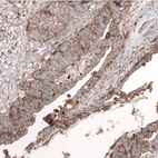 Immunohistochemical staining of human ovarian cancer (papillary carcinoma) shows strong membranous positivity in tumor cells.
