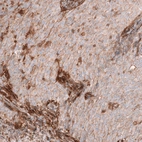 Immunohistochemical staining of human endometrial cancer shows moderate membranous positivity in tumor cells.